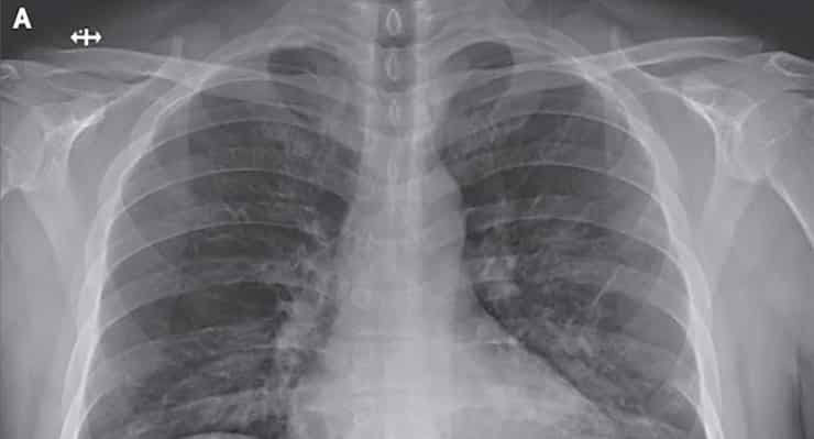 coronavirus patient lungs